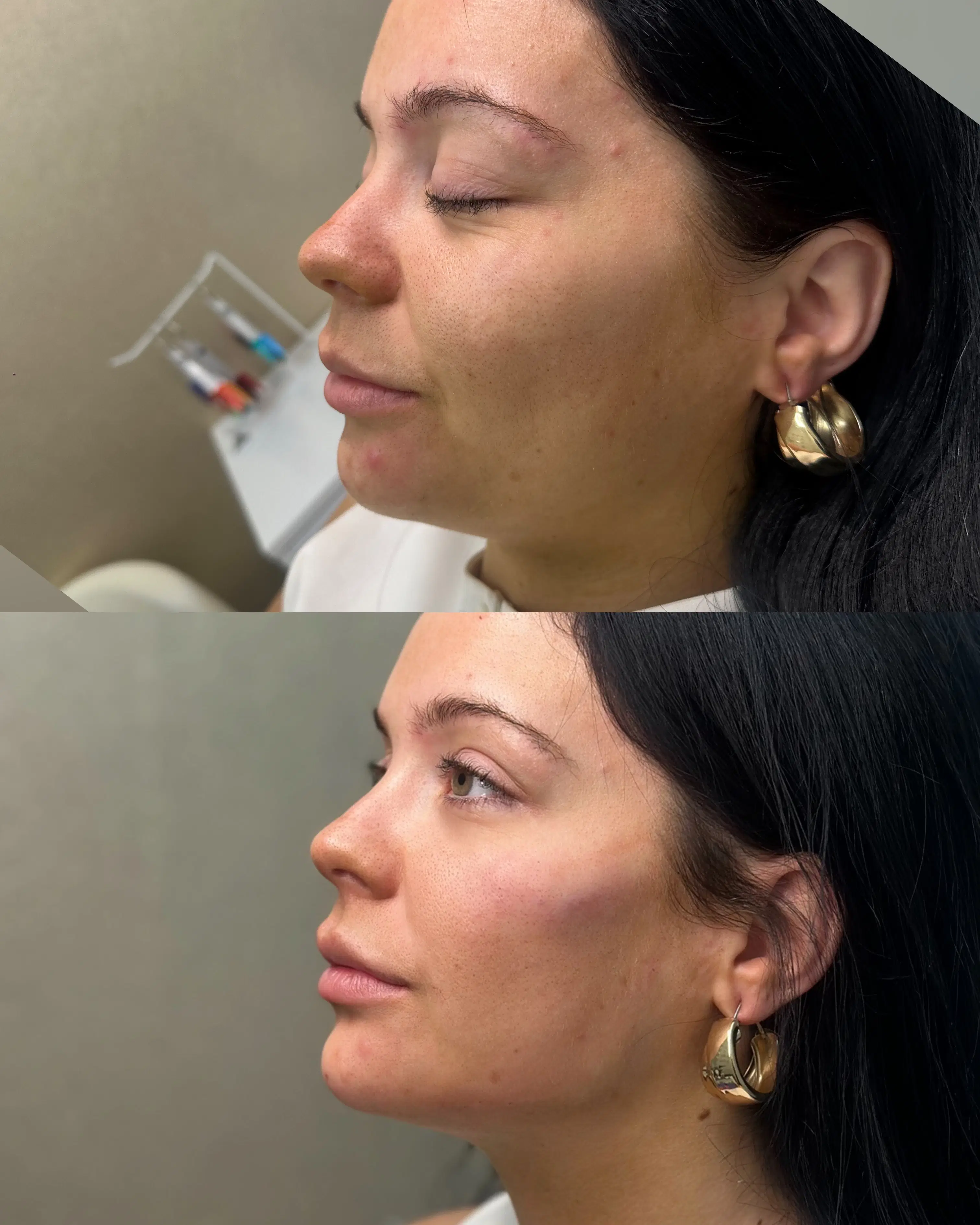 Before-and-after facial profile comparison, with the before image above the after image.