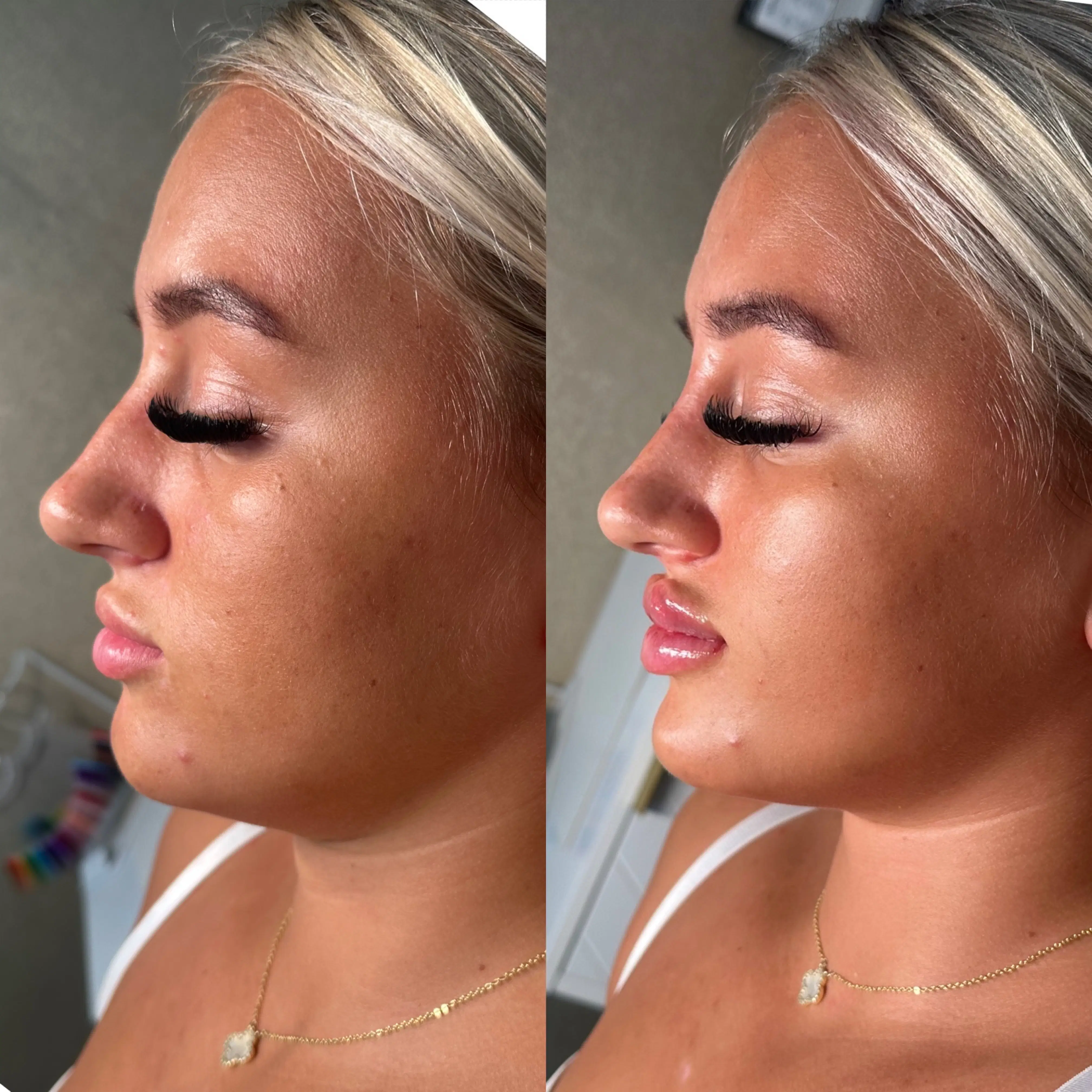 Before-and-after facial profile comparison, with the before image on the left and the after image on the right.