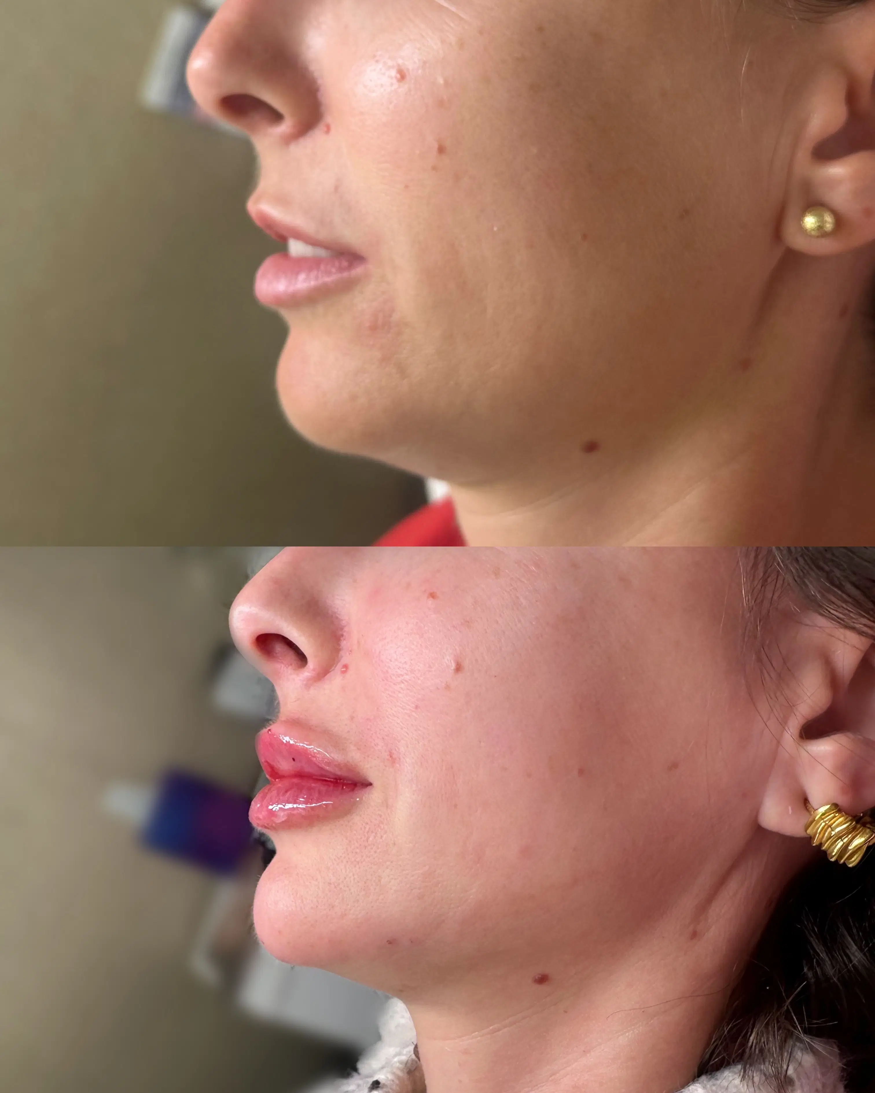 Before-and-after close facial profile comparison, with the before image above the after image.