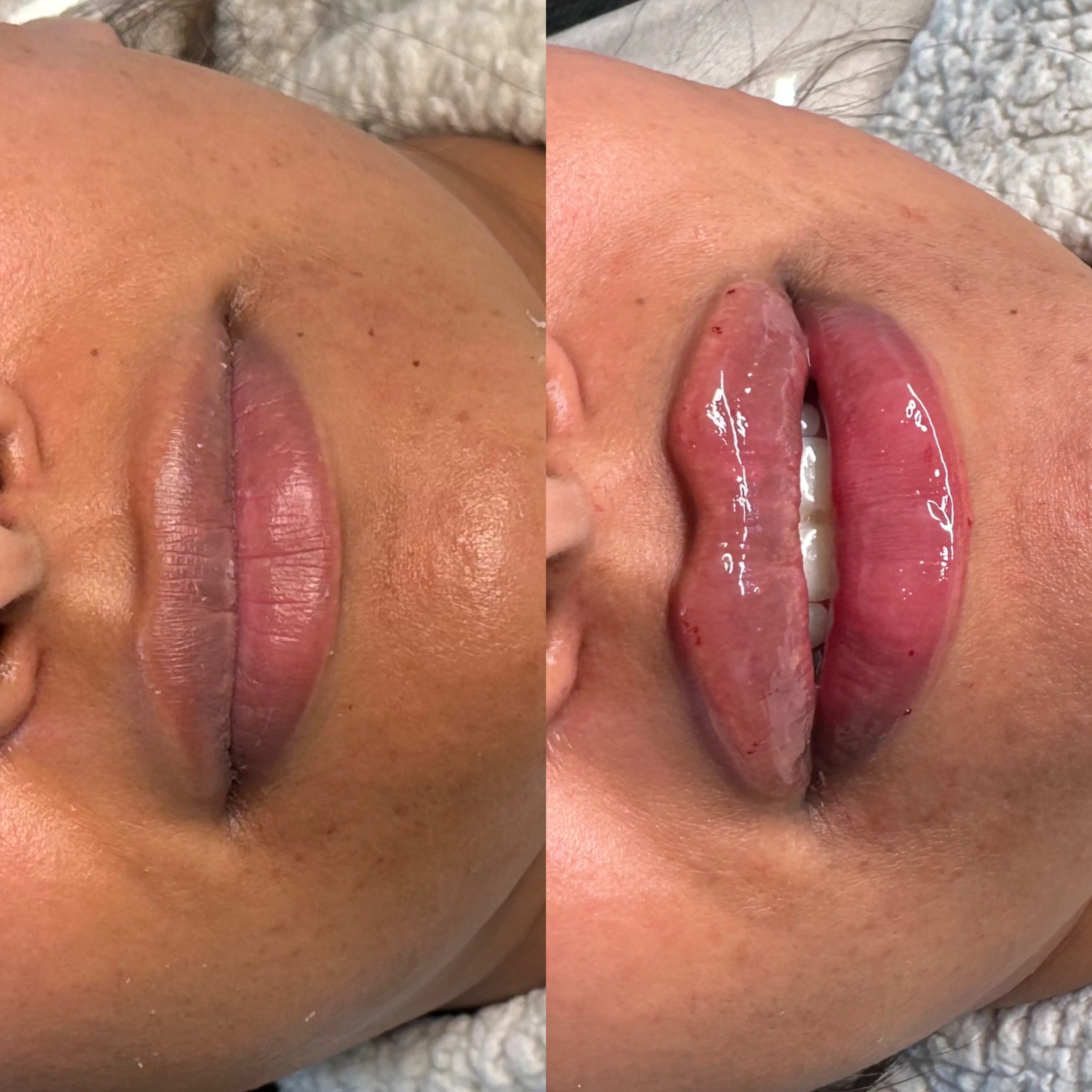 Before-and-after close-up comparison of a client's lips, shown side by side.