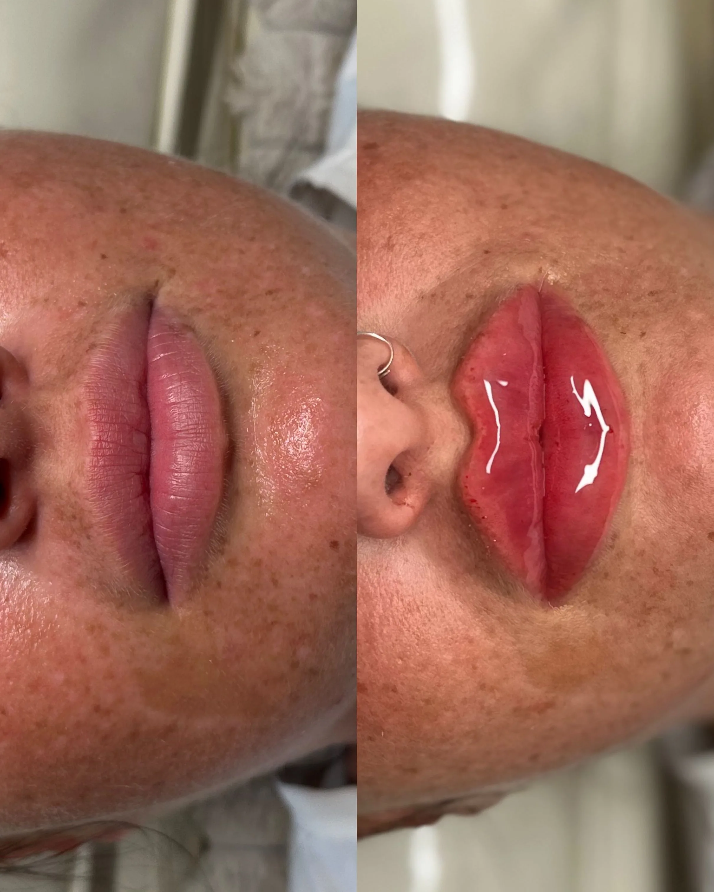 Before-and-after close-up comparison of a client's lips, shown side by side.