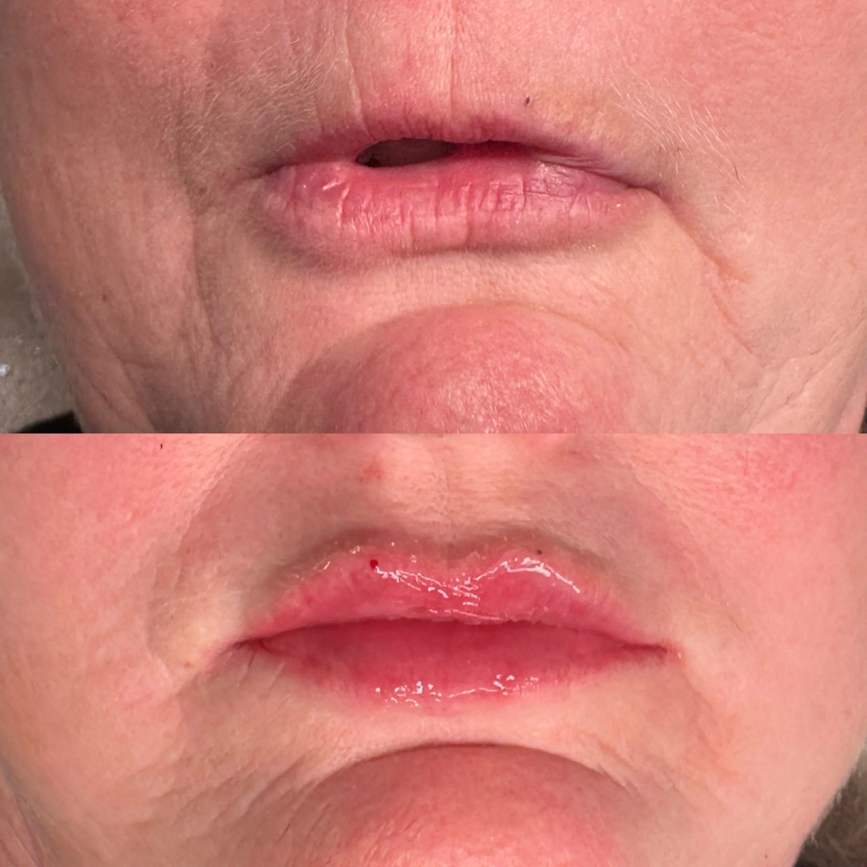 Before-and-after close-up comparison of a client's lips, shown one above the other.