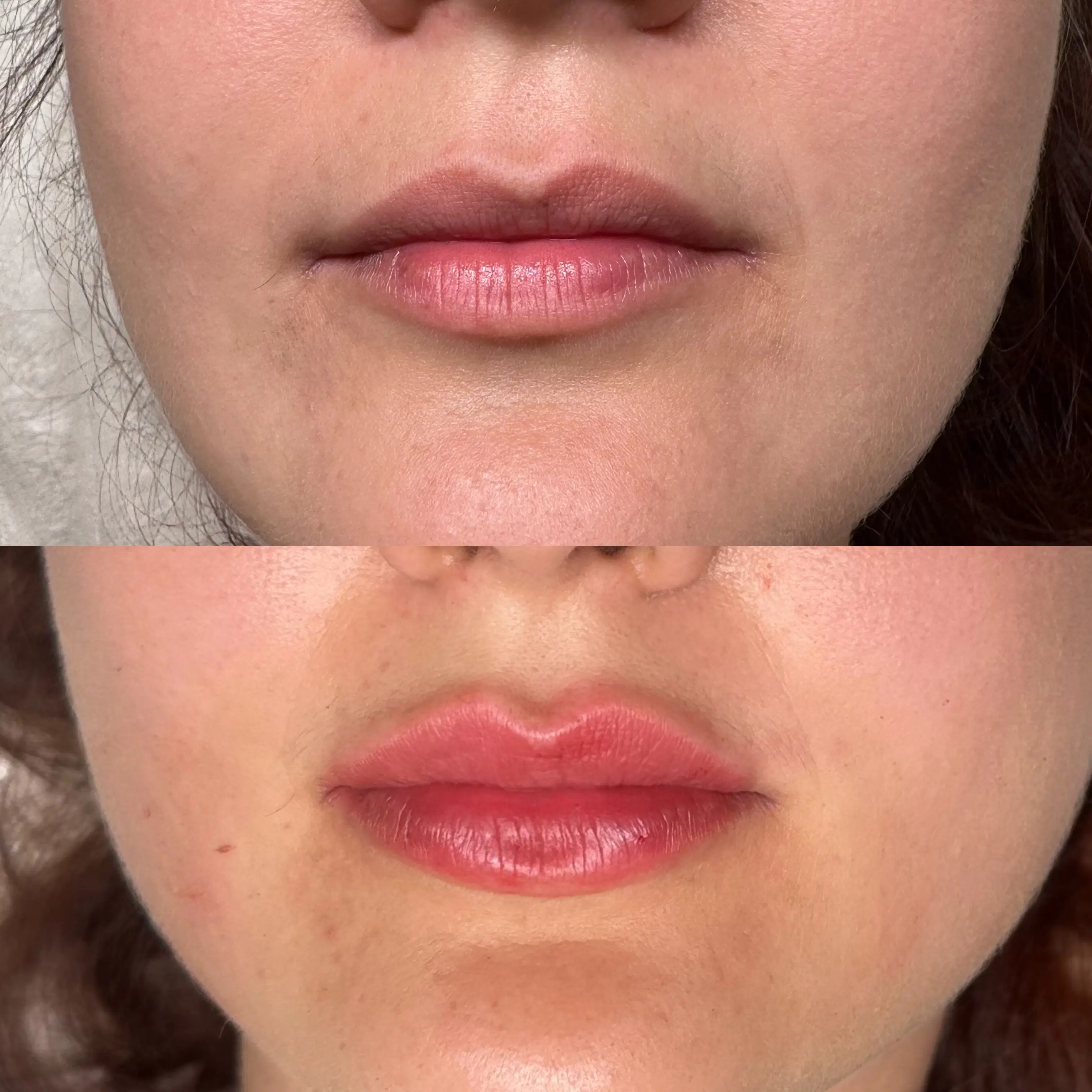 Before-and-after front-facing comparison of a client's lips, shown one above the other.