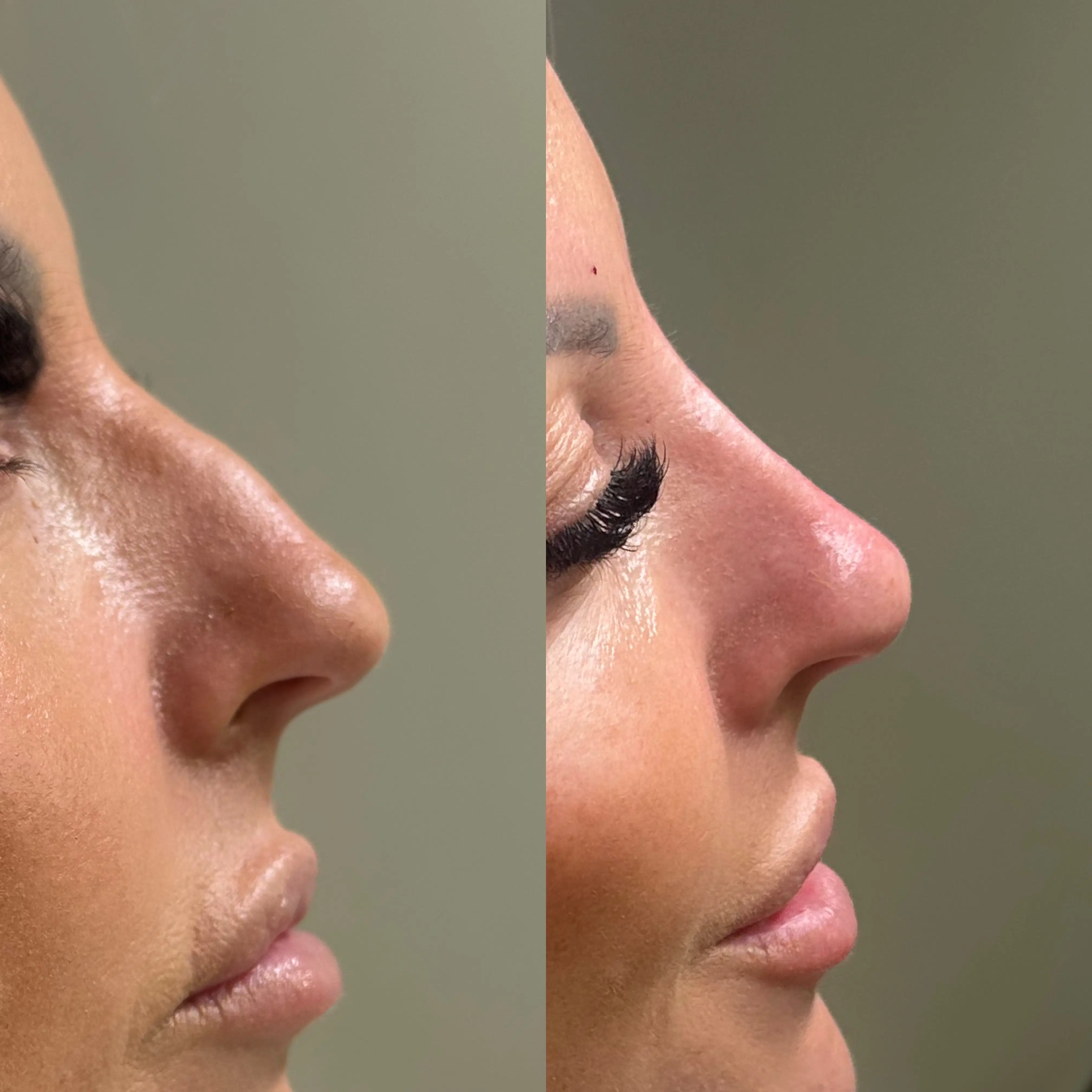 Before-and-after side profile comparison from the Non-Surgical Rhinoplasty and Nose Filler case study