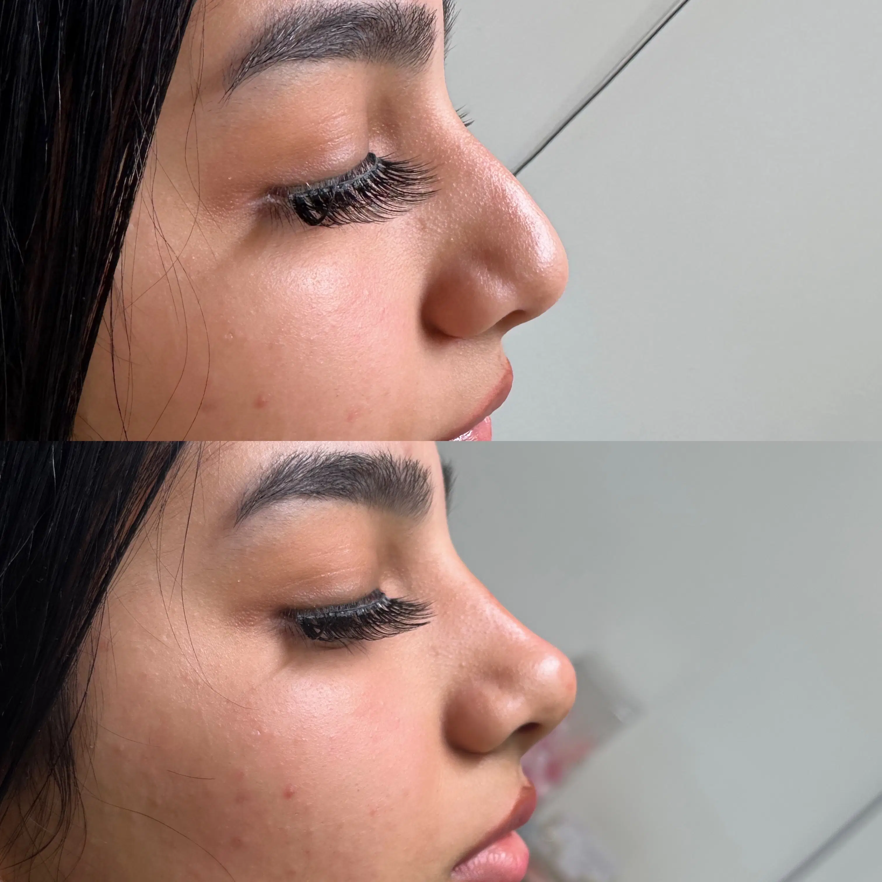 Before-and-after side profile comparison of a client's nose, shown one above the other.