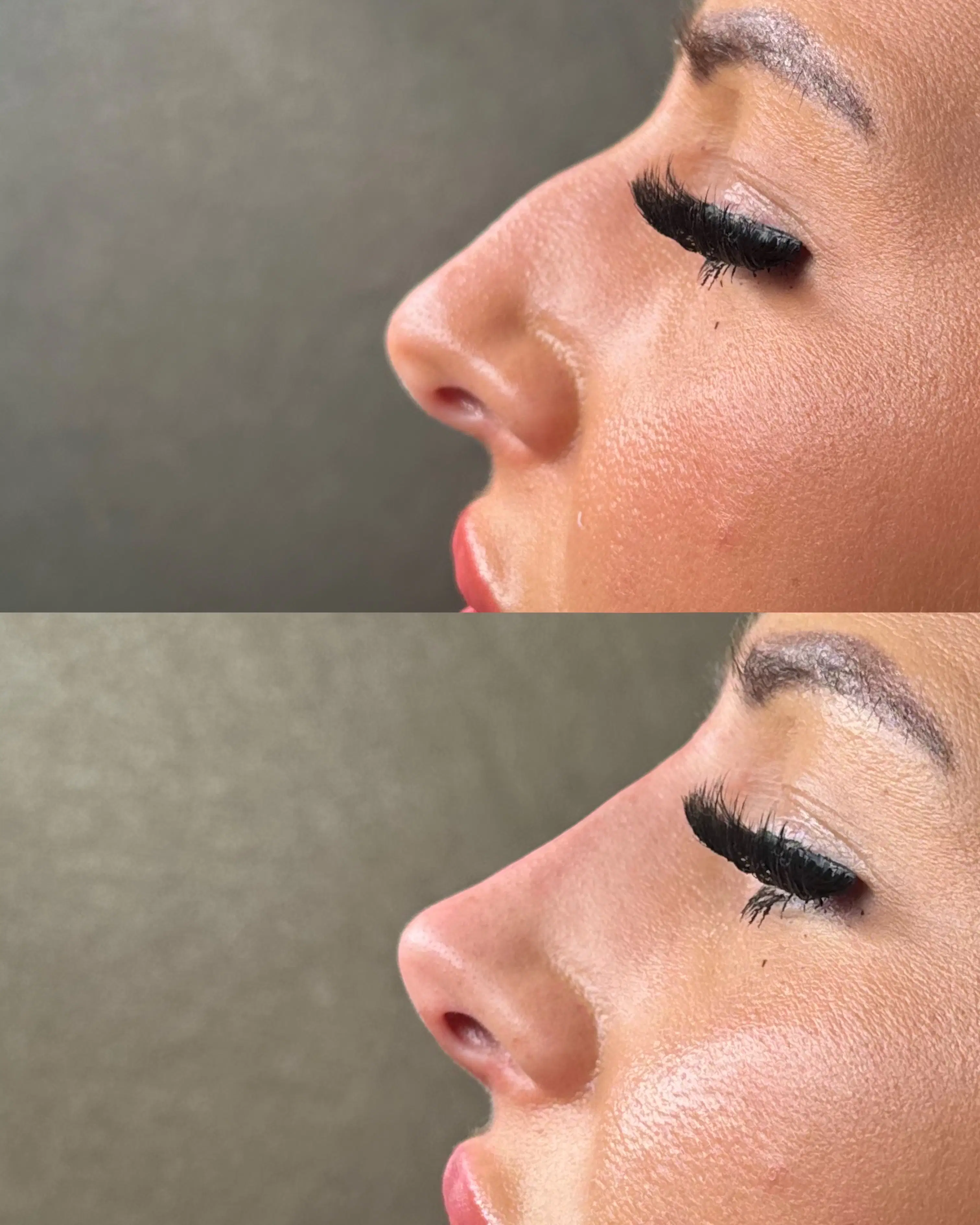 Before-and-after close side profile comparison of a client's nose, shown one above the other.