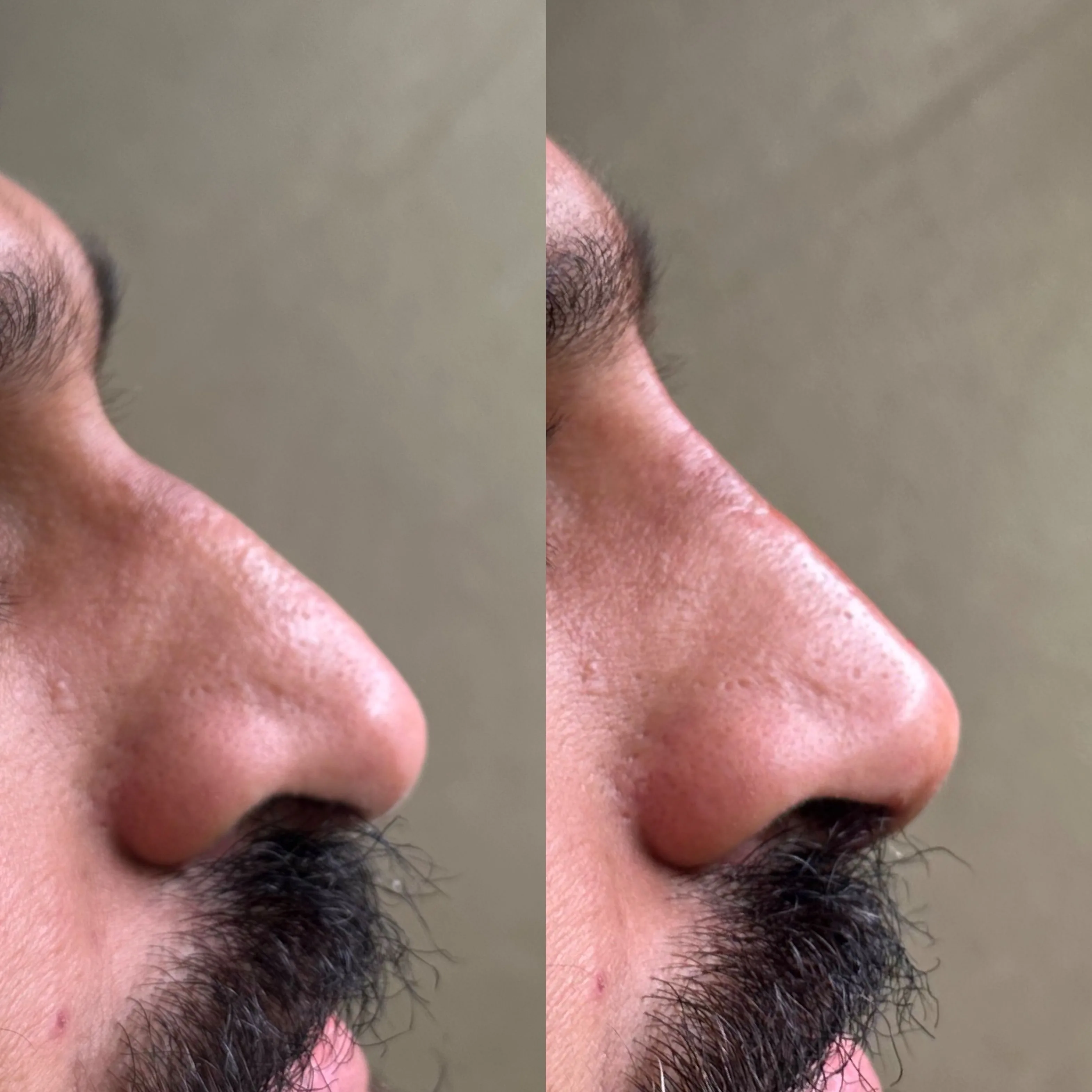 Before-and-after close-up comparison of a client's nose from below, shown side by side.